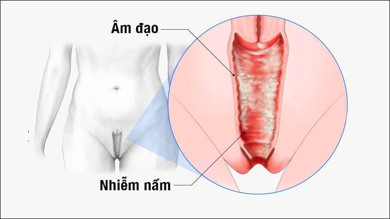 chữa bệnh phụ khoa nấm âm đạo Candida