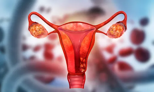 Suy buồng trứng và giải pháp dược liệu thảo mộc