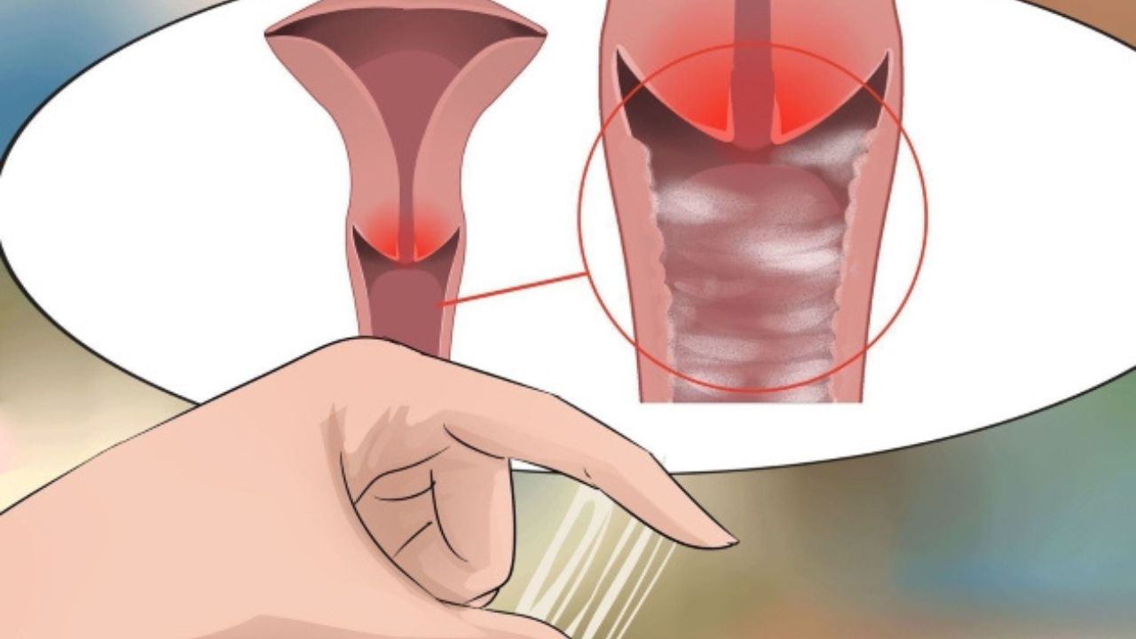 Chữa bệnh viêm âm đạo bằng dược liệu đông y