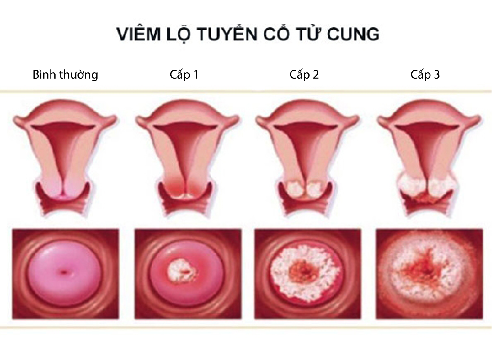 Dược liệu chữa bệnh viêm lộ tuyến cổ tử cung