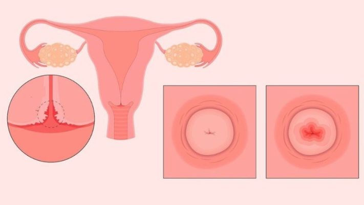 Dược liệu chữa bệnh viêm lộ tuyến cổ tử cung